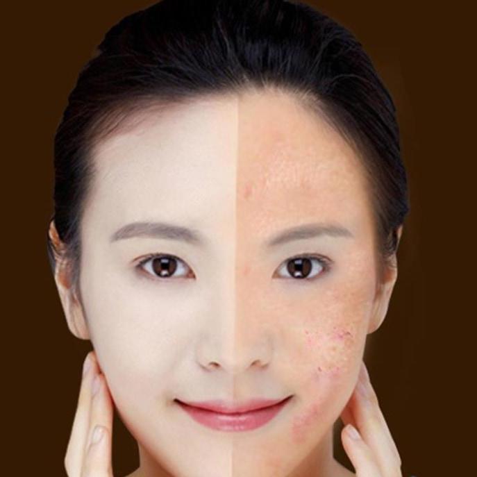 Blue Light Skin Therapy Pen