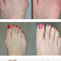 Elastic Bunion Corrector