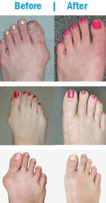 Elastic Bunion Corrector